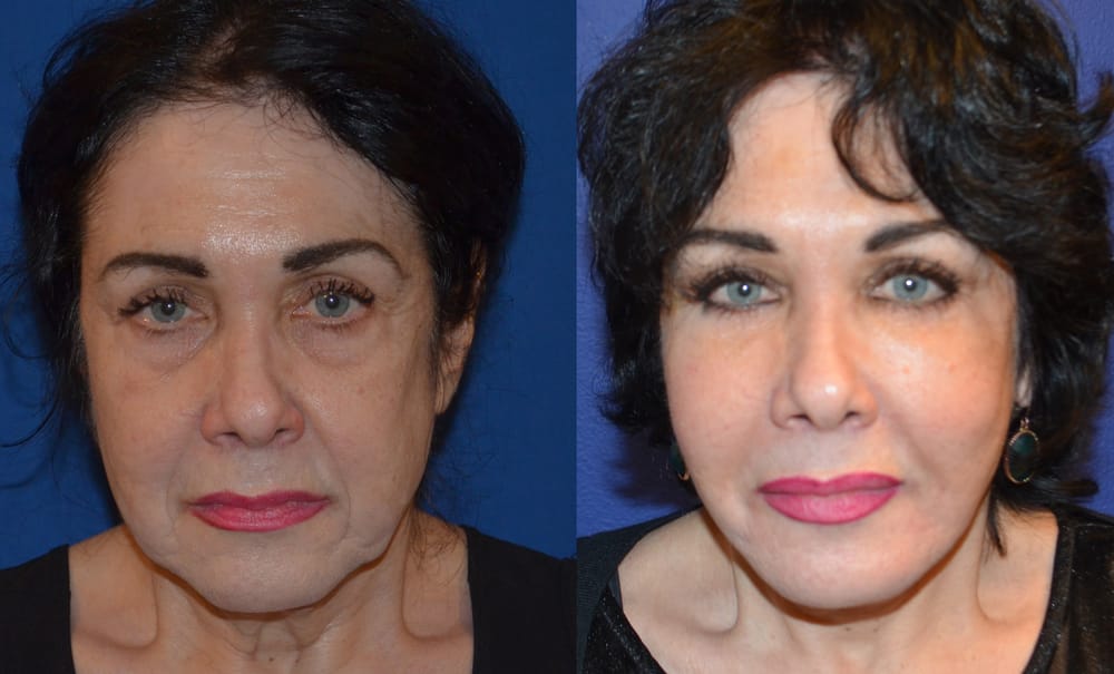 Face, Neck and Lower Eyelid Lift with Fat Transfer to the Cheeks Yelp